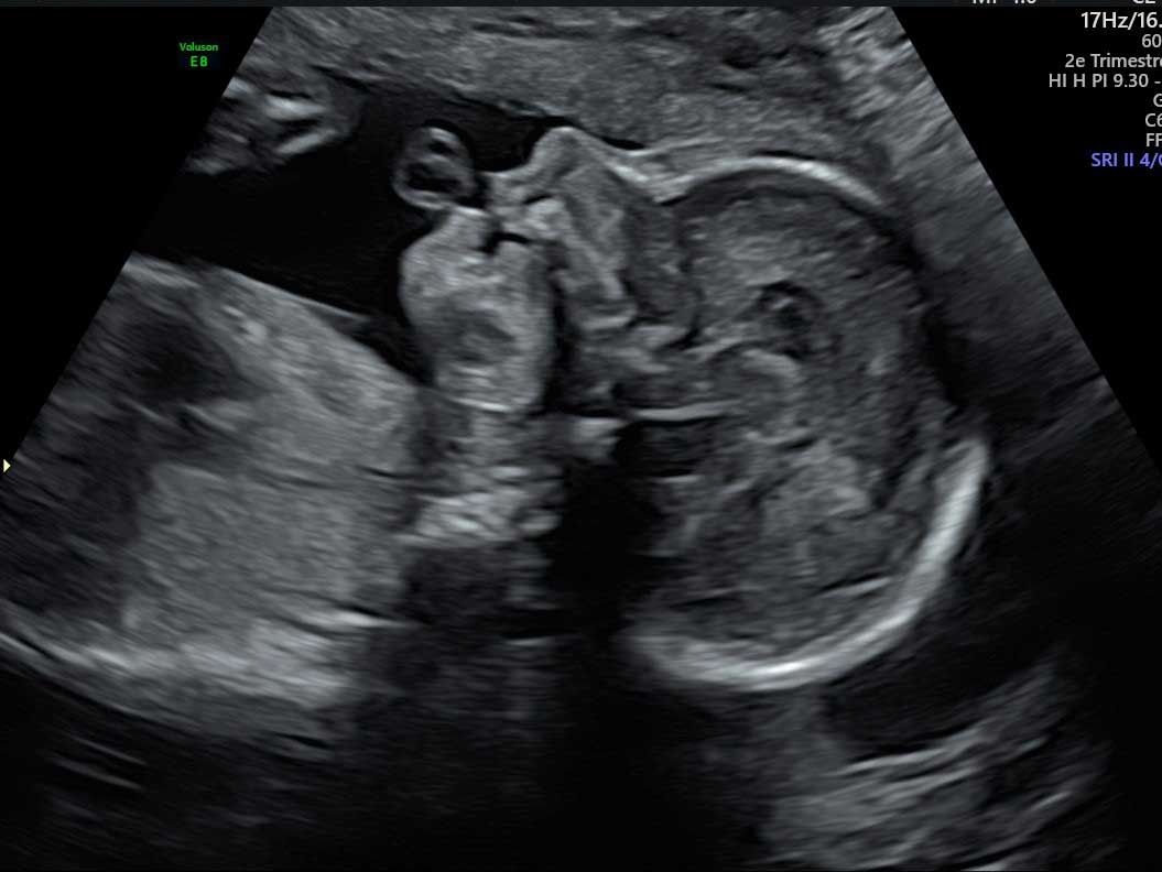 echographie profil bébé